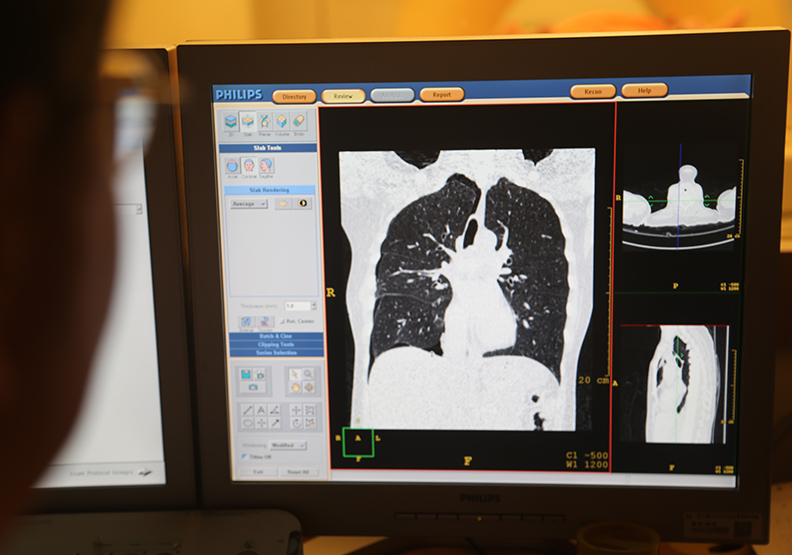 癌症治療大躍進 找到對抗PM2.5疾病的新武器了_img_2