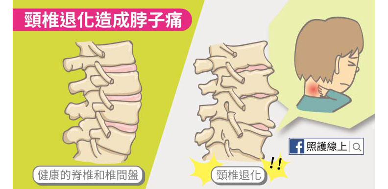 脖子痛是中風前兆？先別慌，這 6 種情況儘早檢查_img_3