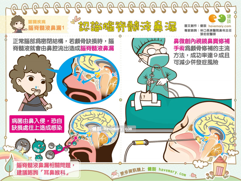 單側不明原因流鼻水?別輕忽,認識「腦脊髓液鼻漏」_img_1