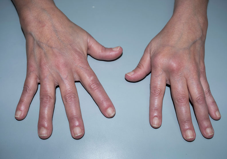 類風濕性關節炎患者看過來!印度研究:勤練瑜珈有助鎮痛解鬱_img_1