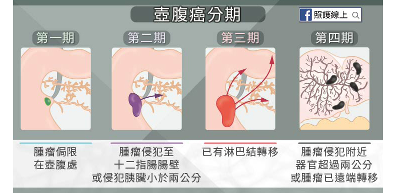 李應元、幸佳慧都因「壺腹癌」病逝!出現腹痛、大便灰白6症狀須留意_img_4