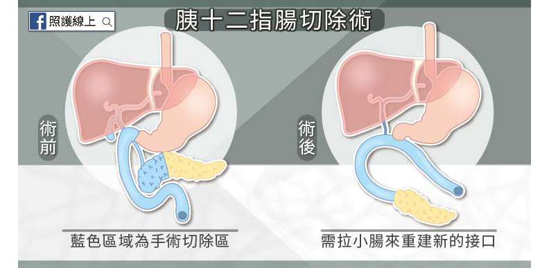 李應元、幸佳慧都因「壺腹癌」病逝!出現腹痛、大便灰白6症狀須留意_img_5