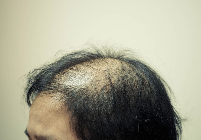 保護頭皮,預防掉髮的 5 種水果_img_1