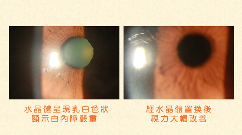 20歲後近視度數短期暴增,原來是因白內障影響!_img_1