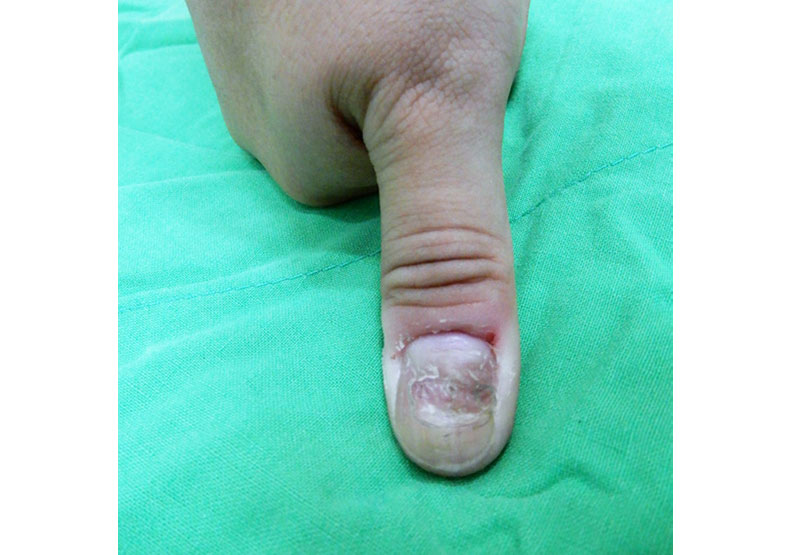 從小學到成人都有的習慣:為什麼會「咬指甲」?_img_1