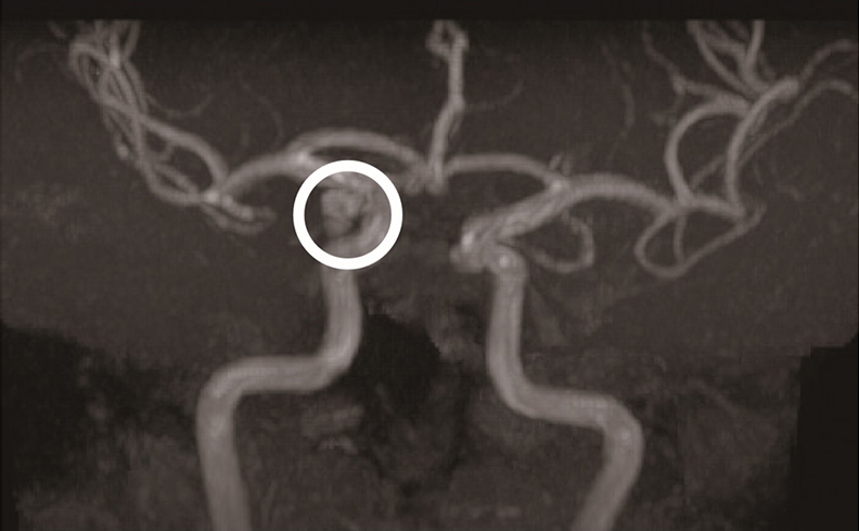 蜘蛛網膜下腔出血是「爆炸般的頭痛」!若三度出血致死率百分百_img_3