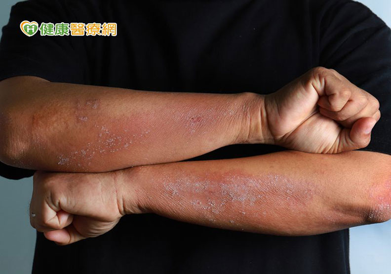 異位性皮膚炎難根治,21歲大學生癢到一度休學無法念書_img_1