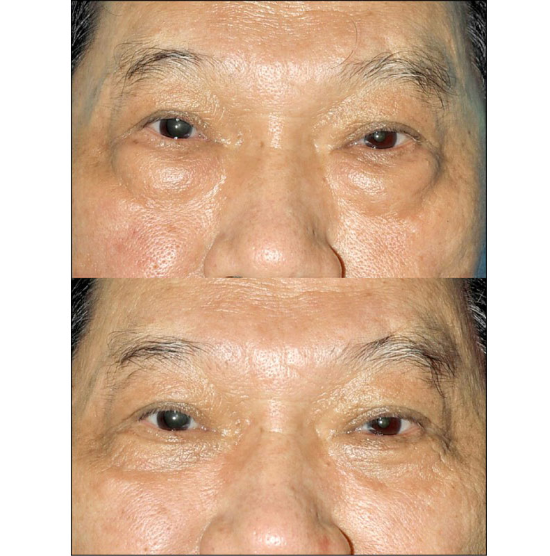 不想變老,除眼袋停看聽_img_2