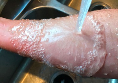 處理燙傷步驟你夠了解嗎？皮膚科醫師：泡＋脫、蓋＋送更好記
