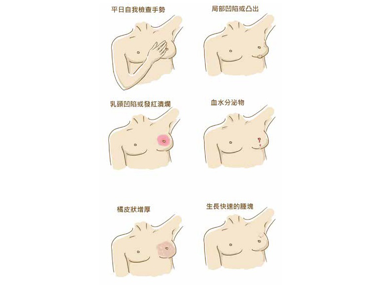 摸到乳房有硬塊,是乳癌嗎?不會痛、位置固定要當心!_img_2