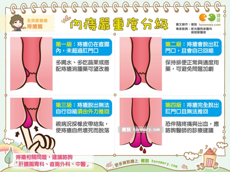 痔瘡脫出導致排便好痛... 4 種分級檢查你的內痔有多嚴重_img_1