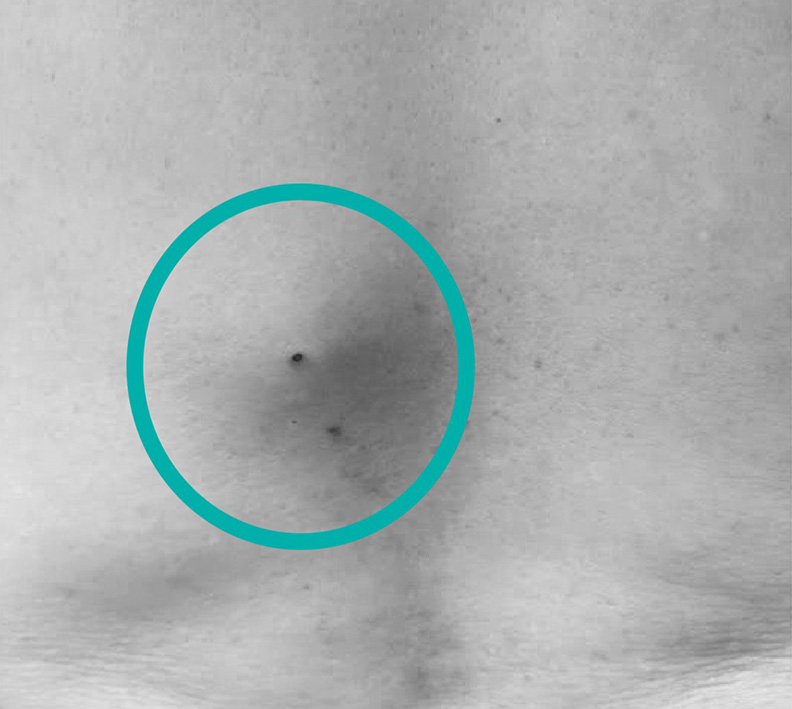 痛到像「長釘子」!粉瘤、疔瘡千萬別自己亂擠_img_1