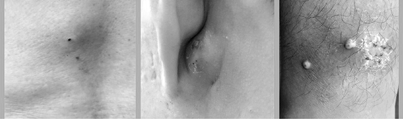 痛到像「長釘子」!粉瘤、疔瘡千萬別自己亂擠_img_3