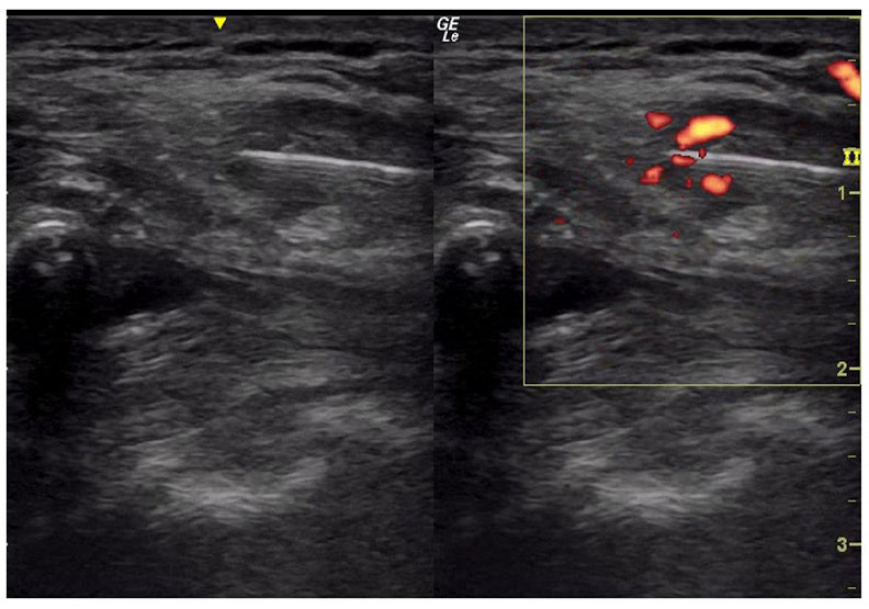 五十肩兩年會自己好？醫學實證的 6 種非手術治療法_img_2