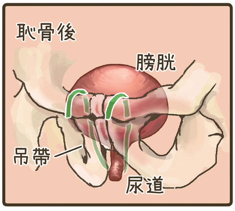 靠凱格爾運動改善尿失禁卻沒成效?常見 3 種手術傷口小、恢復快_img_5