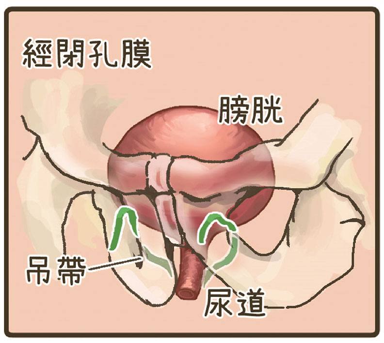 靠凱格爾運動改善尿失禁卻沒成效?常見 3 種手術傷口小、恢復快_img_6