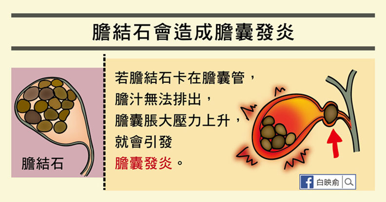 嘔吐發燒又腹痛，膽囊炎發作一定要開刀嗎？_img_1