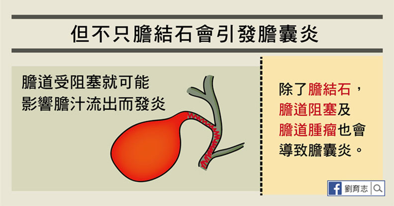 嘔吐發燒又腹痛，膽囊炎發作一定要開刀嗎？_img_2