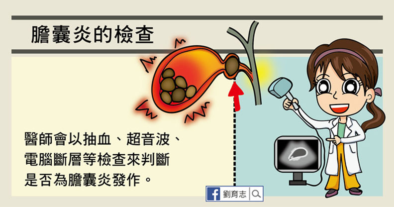 嘔吐發燒又腹痛，膽囊炎發作一定要開刀嗎？_img_4