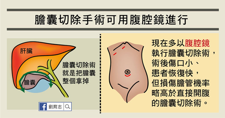 嘔吐發燒又腹痛，膽囊炎發作一定要開刀嗎？_img_7