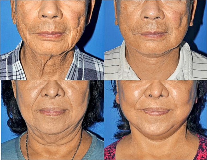 最新拉臉手術,其實是「拉脖子」_img_1