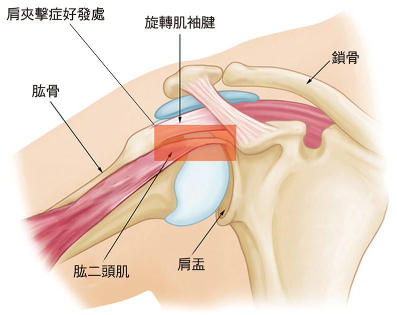 伸懶腰時肩膀劇痛 千萬別把 肩盂肱關節夾擊症 誤當五十肩 遠流出版 健康遠見