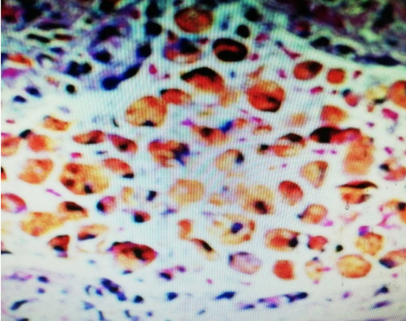 天氣轉涼吃太補,24歲女性眼睛出血竟出現「鐵結晶」_img_3