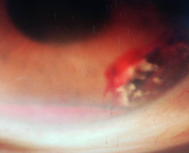 天氣轉涼吃太補,24歲女性眼睛出血竟出現「鐵結晶」_img_4