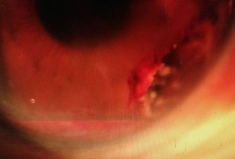 天氣轉涼吃太補,24歲女性眼睛出血竟出現「鐵結晶」_img_5