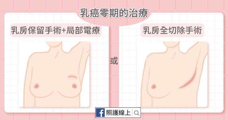 乳癌零期的治療