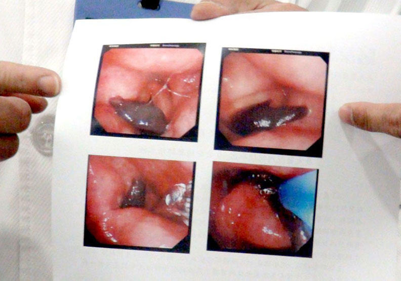 醫師在女子聲門附近發現一隻10公分左右的肥胖水蛭;取自聯合新聞網。