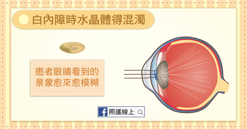 得白內障時水晶體變得混濁。