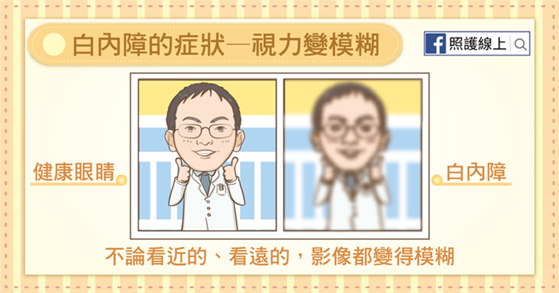 白內障的症狀——視力變模糊。