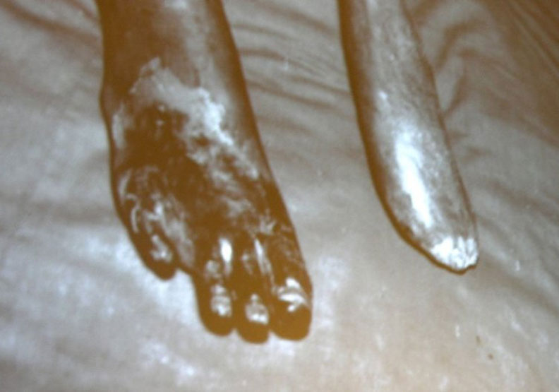 台灣烏腳病醫療紀念館播放烏腳病患的老照片,清楚呈現壞死的腳趾和截去腳趾的腳掌,令人心酸。聯合新聞網提供