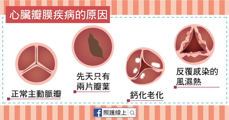 心臟瓣膜疾病的原因。
