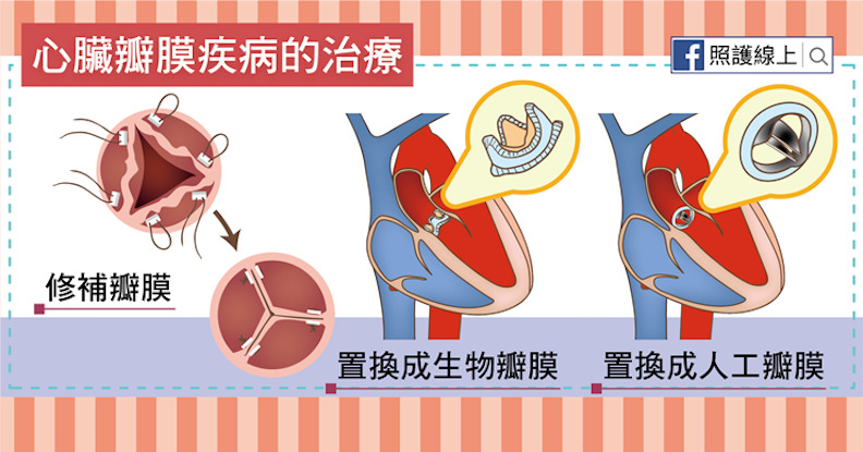 心臟瓣膜疾病的治療。