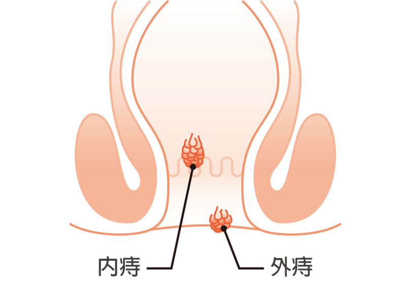 內痔與外痣的位置。
