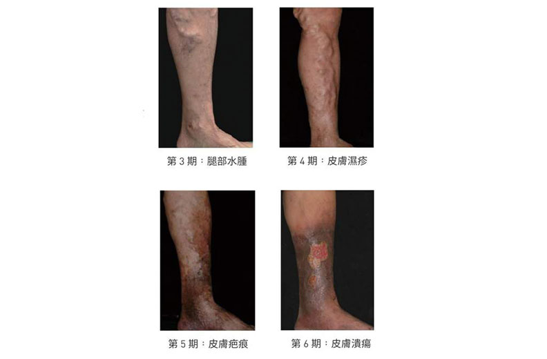 靜脈曲張分期。