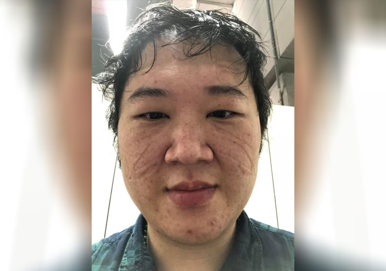 圖/台北市立聯合醫院胸腔科主治醫師鄒冠全在個人臉書貼出一張令人感動的自拍照。照片中的他從鼻樑到兩頰是深深的壓痕。鄒冠全提供