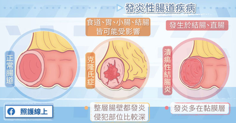 發炎性腸道疾病