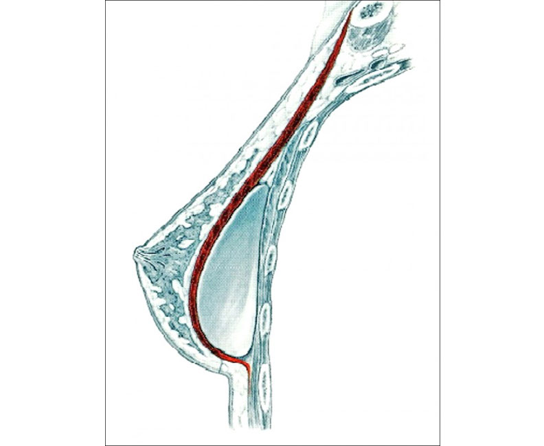 結束隆乳須考慮本身乳房皮膚是否下垂、義乳空間縫合等問題;林靜芸提供。