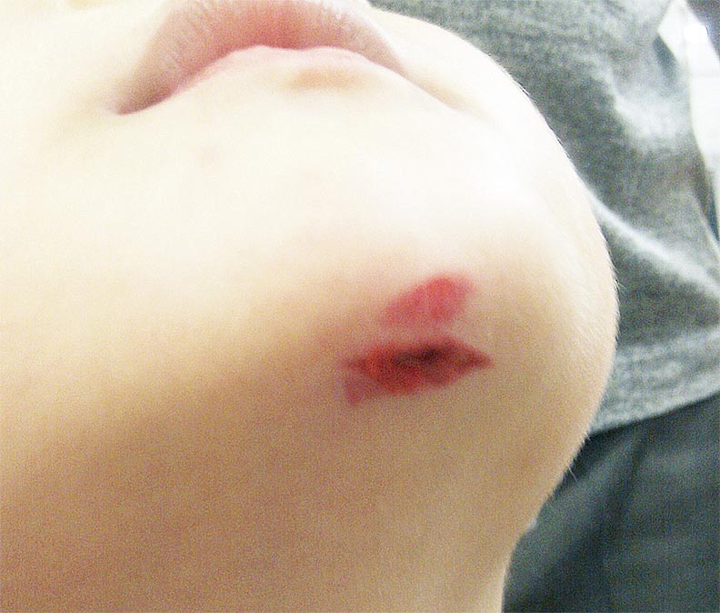 換藥時,傷口要完整地清洗。