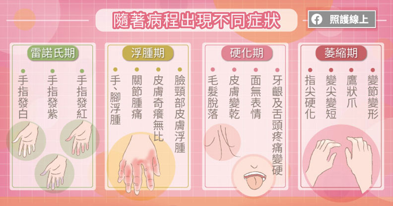 硬皮症會隨著病程出現不同症狀。