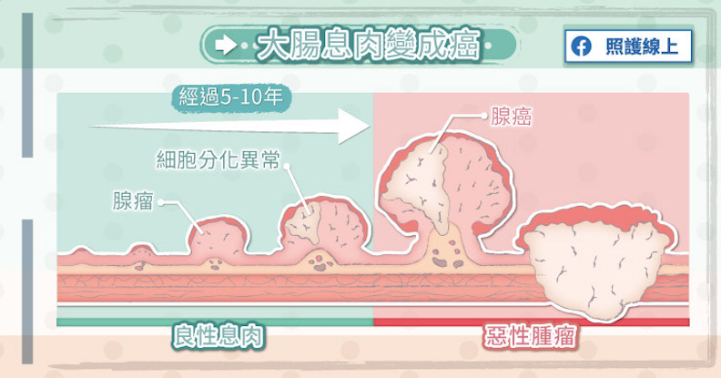 大腸息肉變成癌。