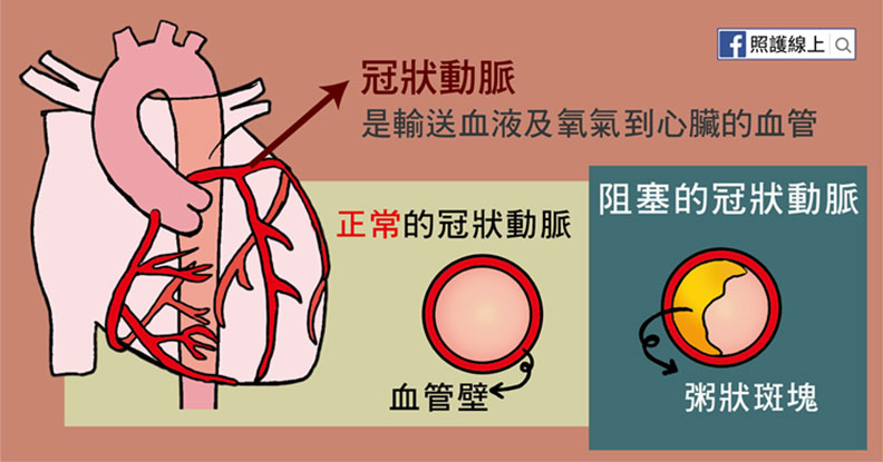 冠狀動脈是輸送血液及氧氣到心臟的血管。