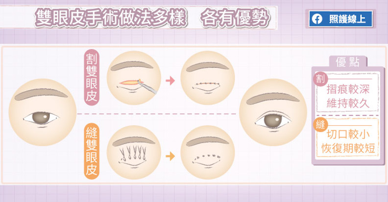 雙眼皮手術做法多樣,各有優勢。
