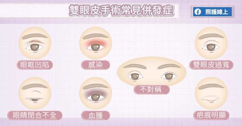 雙眼皮手術常見併發症。