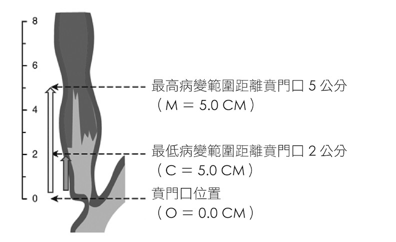 取自sharmn P. et.al. Gastroenterology 2006.NOV.131(5): 1392-9