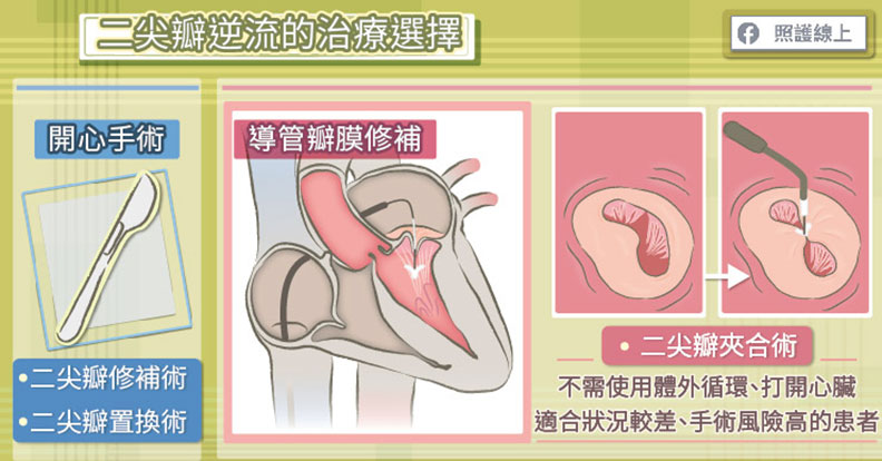 二尖瓣逆流治療選擇。
