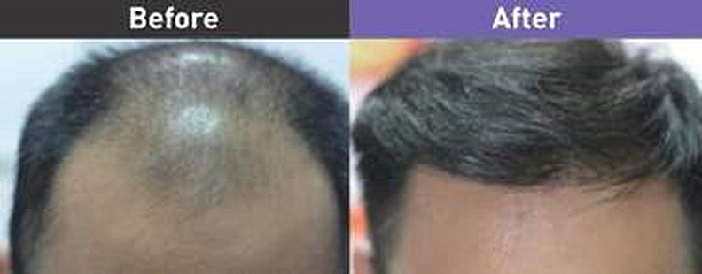 第4期雄性禿手術前及術後3年（一次移植1500株毛囊單位）。